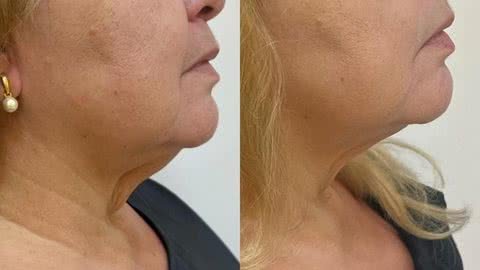 O Endolifting é um procedimento minimamente invasivo que trata a flacidez e a gordura facial e de pescoço - Créditos: Arquivo Dra. Erika Kugler