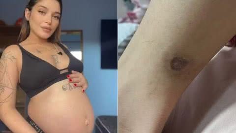 A picada da aranha trouxe traumas para Ketisley - Imagem: Divulgação/ G1