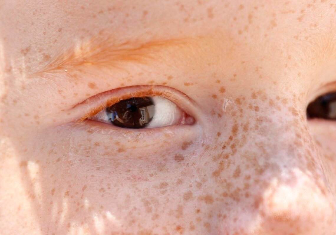 Reflexo branco nos olhos: entenda condição que assusta pais