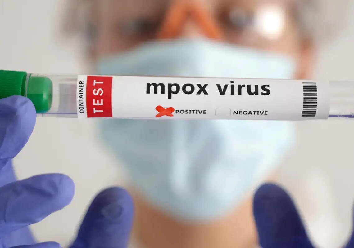 Secretaria de Saúde confirma segundo caso de mpox do grupo lp em SP